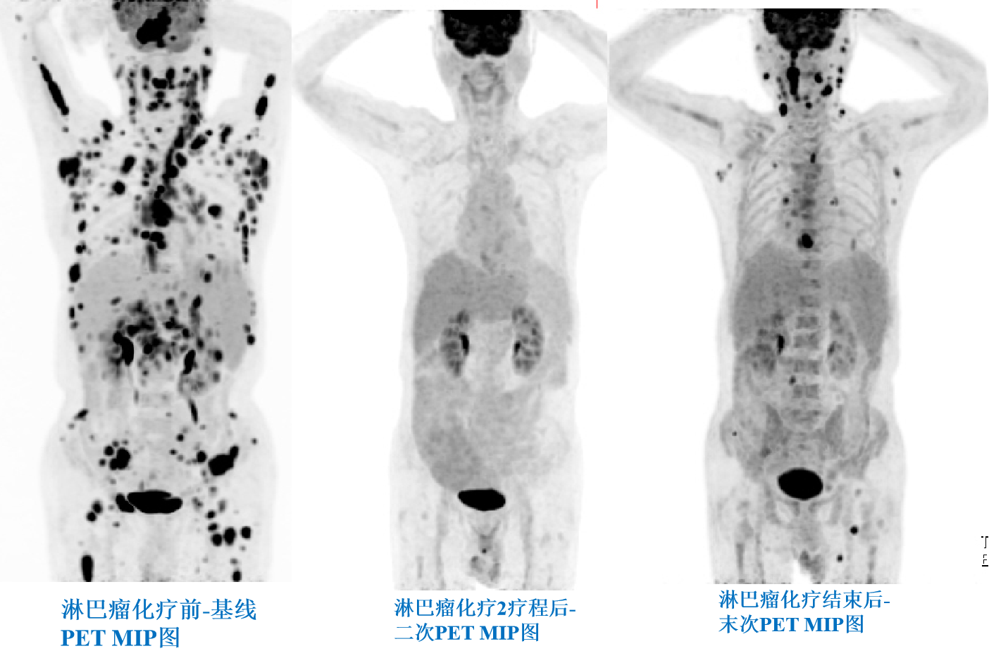 淋巴瘤化療前、中、后PETCT療效評(píng)價(jià).png