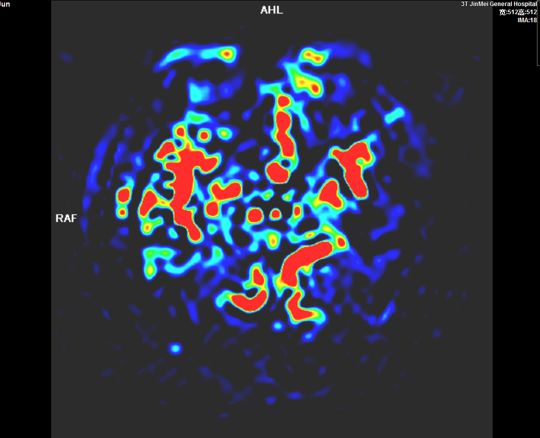 頭顱灌注成像ASL.PNG